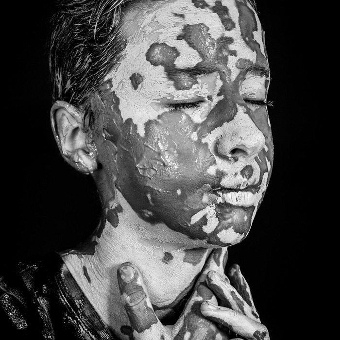 피부 색소 문제