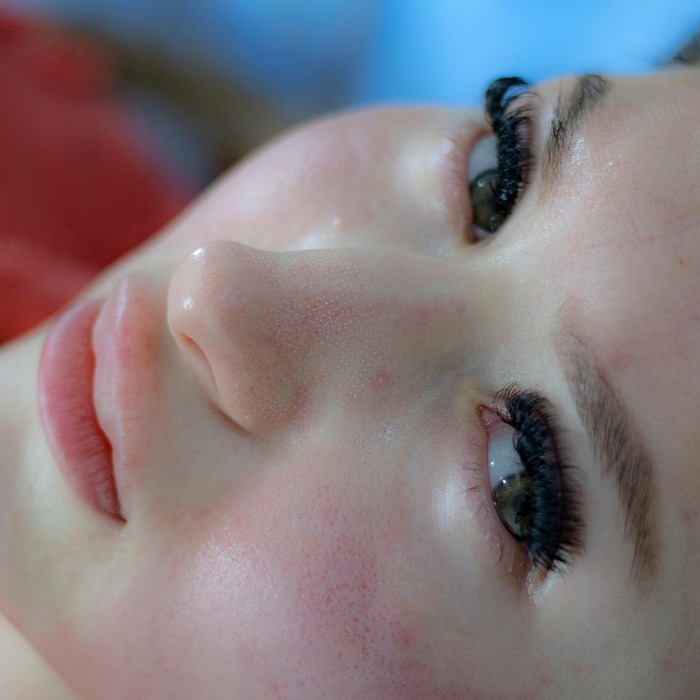 여드름 치료 효과